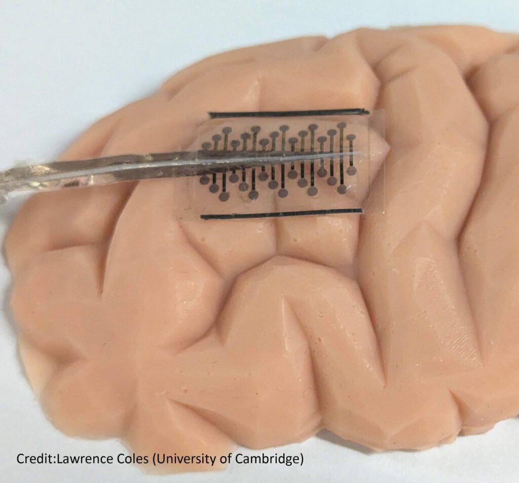 Tiny folding implants improve epilepsy surgery and diagnosis